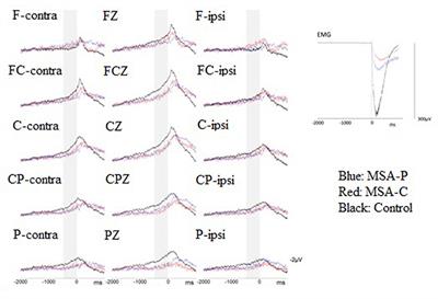 Bereitschaftspotential in Multiple System Atrophy